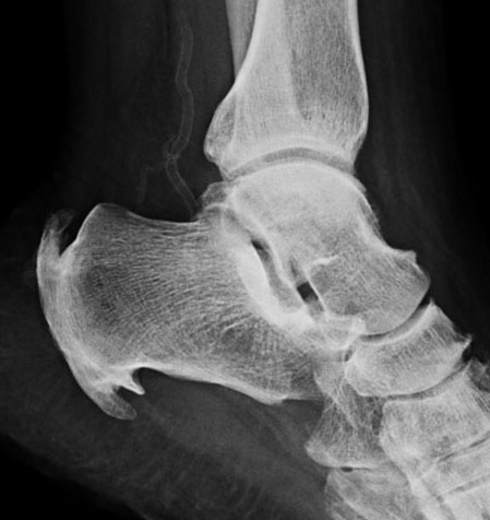 imagerie_pathologie_arriere_pied - UNE ANOMALIE EN ZONE D'ENTHESE